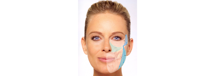 Volume therapy in windmill technique, starlike injections, fills in sunken areas of the face. The experts of Rosenpark Clinic can achieved results with that technique that were previously only possible through extensive facelift surgeries.