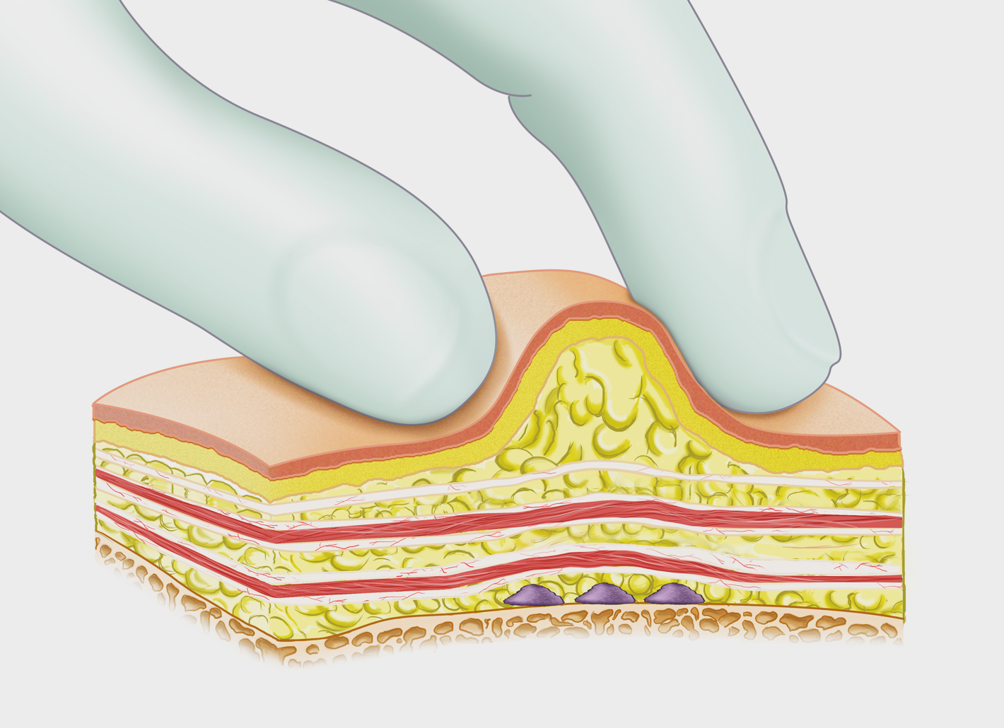 Mit der Depot-Technik werden in der Rosenpark Klinik Filler punktuell ins Gewebe gesetzt.