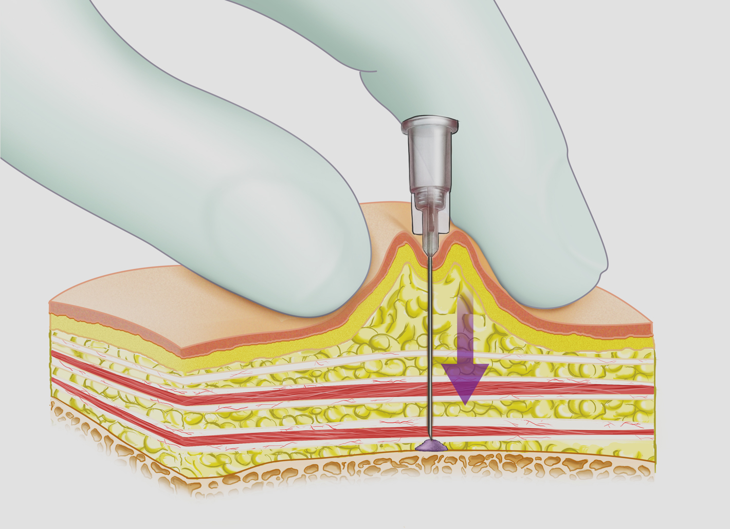 F&uuml;r die Tower-Technik in der Rosenpark Klinik dringt die Nadel senkrecht ins Gewebe ein und setzt eine Filler-S&auml;ule - einen Turm - in alle Schichten der Haut und des Unterhautgewebes.