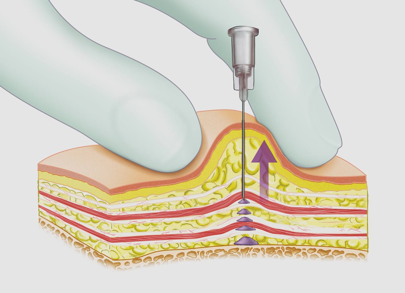 Die Tower-Technik in der Rosenpark Klinik: W&auml;hrend die Nadel aus der Tiefe des Gewebes gezogen wird, gibt sie gleichm&auml;&szlig;ig den Filler ab - kleine S&auml;ulen entstehen und geben dem Gewebe Halt und Volumen.