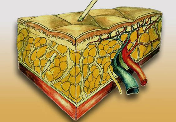Larger quantities of highly diluted anesthesia solution are inserted into the subcutaneous tissue for tumescent local anesthesia.