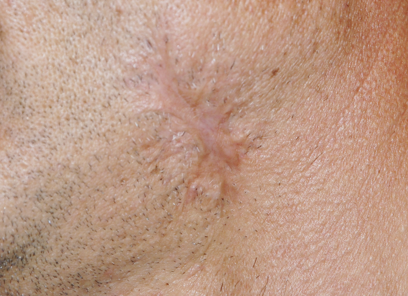 Die chirurgische Narbenkorrektur in der Rosenpark Klinik entfernt unsch&ouml;nes Narbenmaterial und regt eine neue Wundheilung an. Nach der Abheilung ist die Narbe deutlich unauff&auml;lliger.