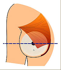 F&uuml;r die Brustvergr&ouml;&szlig;erung gibt es verschiedene Zug&auml;nge und Implantatlagen.