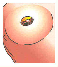 Brust-OP-Zugang oberhalb der Brustwarze