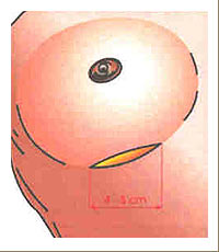 Brust-OP-Zugang in der Unterbrustfalte