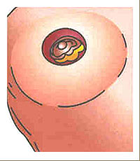 Brust-OP-Zugang am Brustwarzenrand