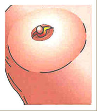 Brust-OP-Zugang durch die Brustwarze