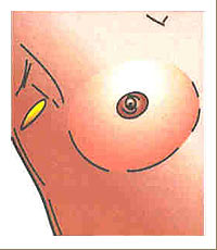 Brust-OP-Zugang durch die Achselh&ouml;hle