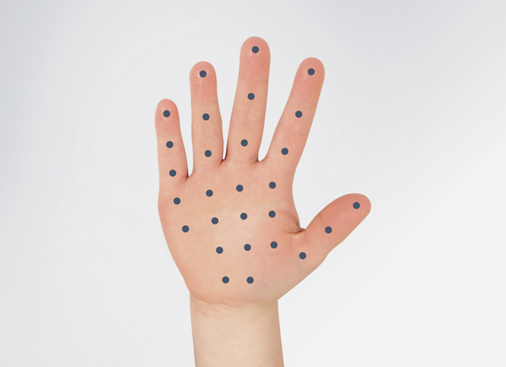 In der Rosenpark Klinik werden übermäßig aktive Schweißdrüsen an den Händen mit Botox® stillgelegt. In der Rosenpark Klinik werden übermäßig aktive Schweißdrüsen an den Händen mit Botox® stillgelegt.