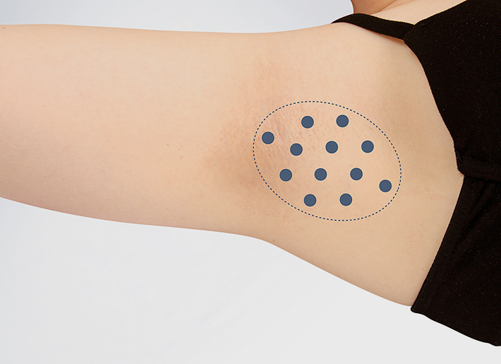 Unkontrolliert arbeitende Schweißzellen in den Achselhöhlen werden in der Rosenpark Klinik mit Botox® blockiert oder mit Laserlipolyse und Saugkürettage dauerhaft entfernt. Unkontrolliert arbeitende Schweißzellen in den Achselhöhlen werden in der Rosenpark Klinik mit Botox® blockiert oder mit Laserlipolyse und Saugkürettage dauerhaft entfernt.