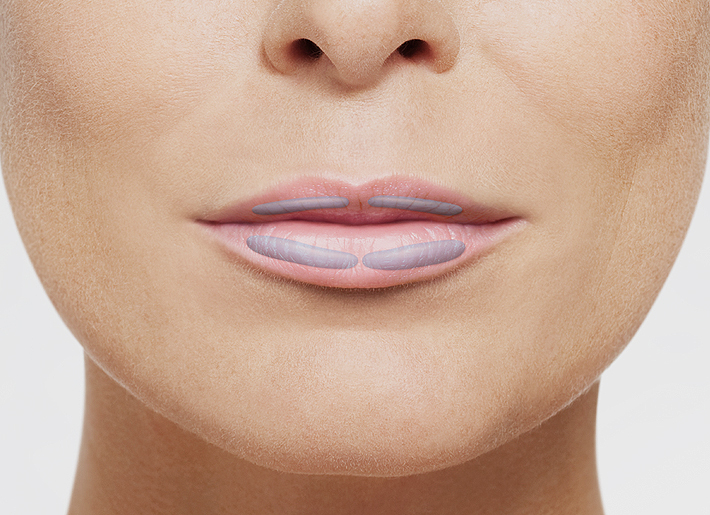 Over the course of time, the lips inevitably lose volume and tissue tone. With significant experience in lip treatments and a gentle injection technique, the specialists of Rosenpark Clinic give them back their natural fullness and beautiful contours.
