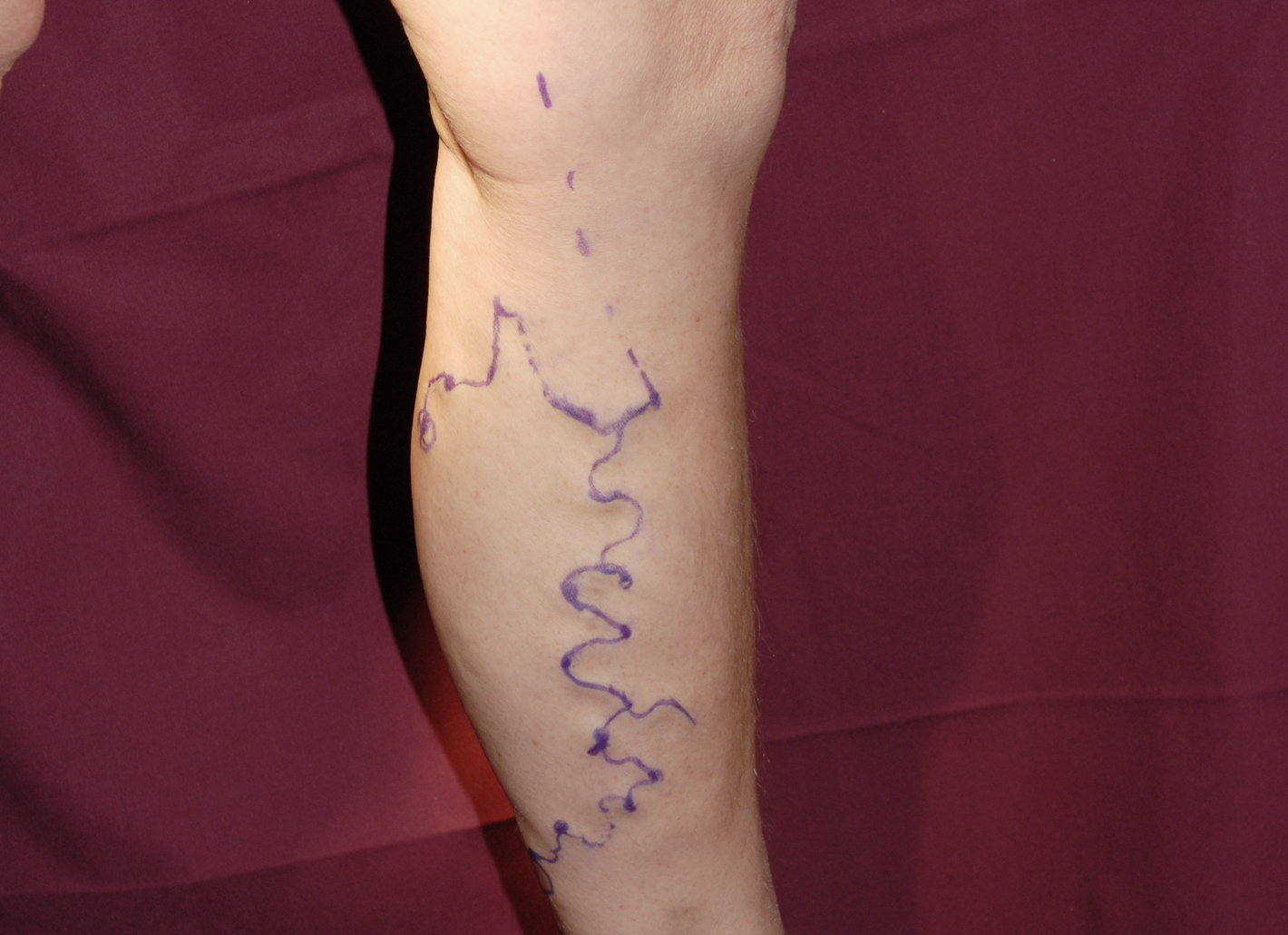 Varicose veins sometimes appear gnarled under the skin. If left untreated, they can promote congestion, thromboses, vein inflammation and ulcers.