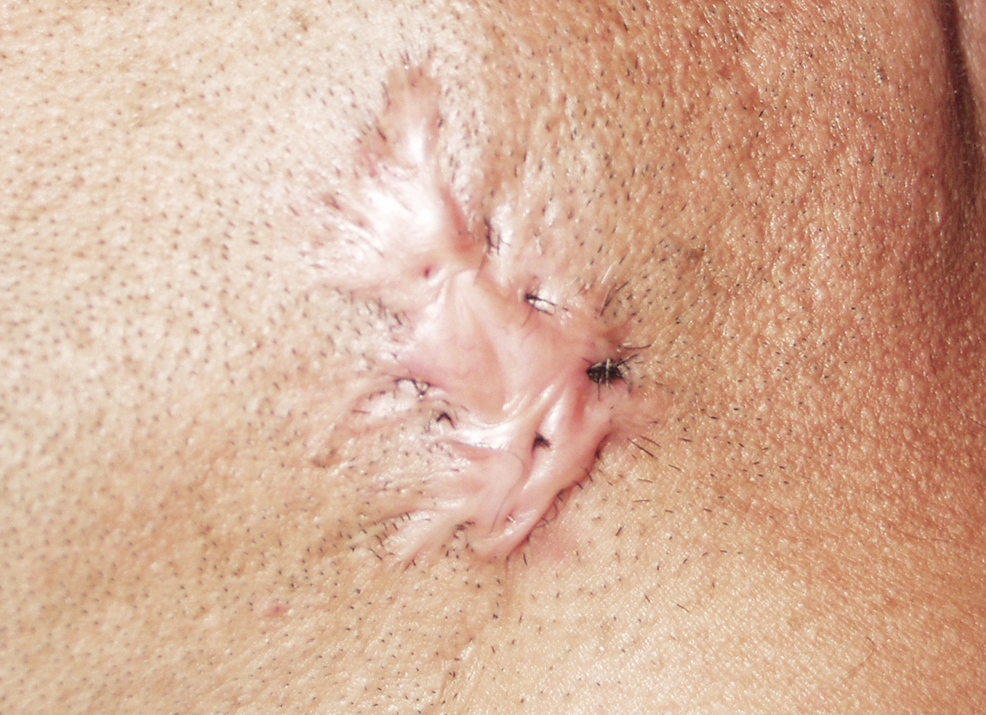 Vor der chirurgischen Narbenkorrektur in der Rosenpark Klinik tritt das Wundmal wuchernd hervor.