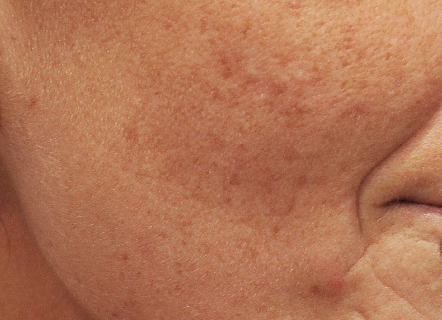 Genetisch bedingte Hautalterung und &uuml;berm&auml;&szlig;ige Sonnenb&auml;der zeigen sich auf der Haut h&auml;ufig als Pigmentst&ouml;rungen und Altersflecken. Vor der Therapie steht eine eingehende Hautanalyse.