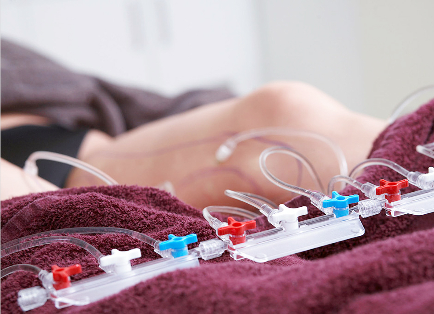 Large quantities of anesthesia solution are injected into the tissue to be treated slowly and in a controlled manner for tumescent local anesthesia at Rosenpark Clinic.