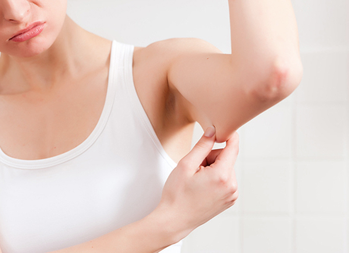 Surgeons at Rosenpark Clinic eliminate extreme excess skin with an upper arm lift.