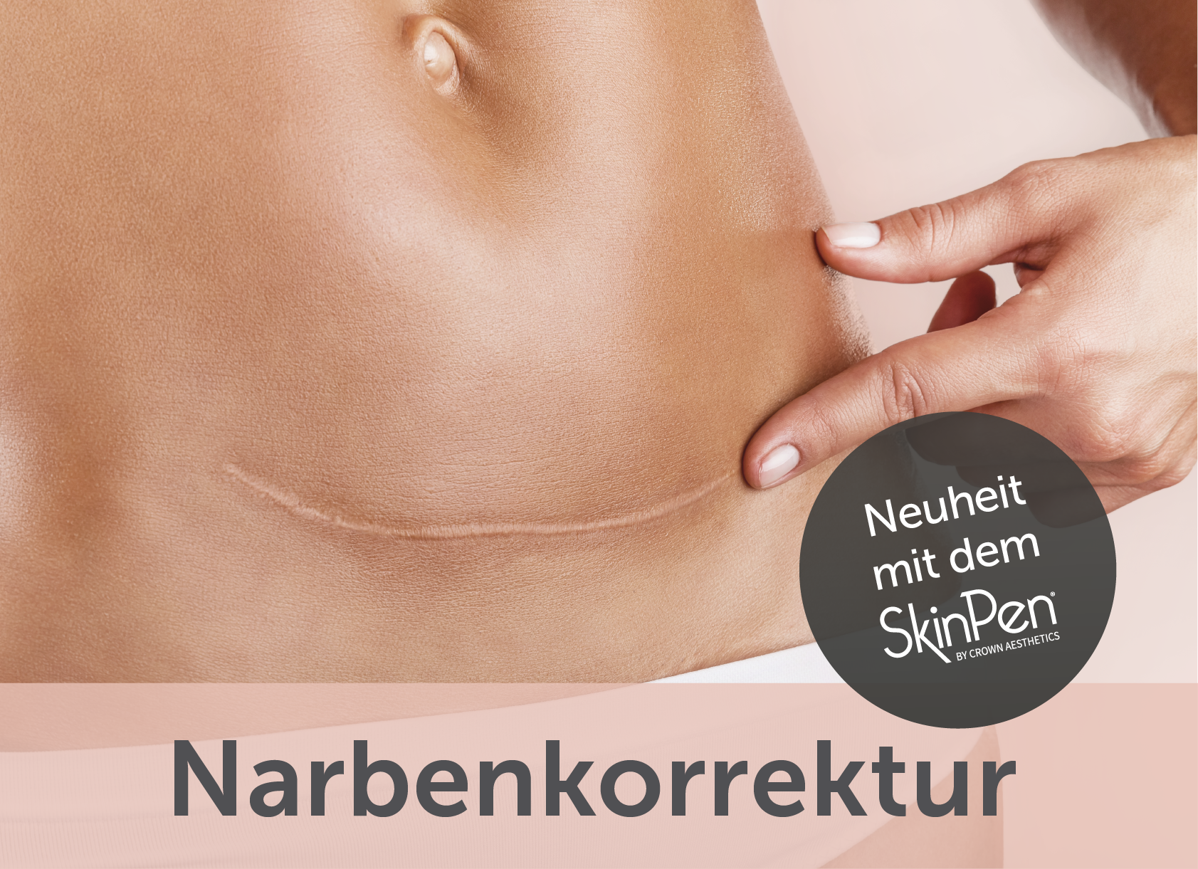 Narbenkorrektur mit dem SkinPen